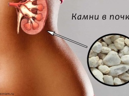 Российские ученые разработали новый метод выведения почечных камней