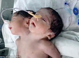 Новорожденный с двумя головами в Индии, к сожалению, скончался через 32 часа