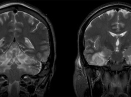 Уменьшение мозга при биполярном расстройстве локализовали