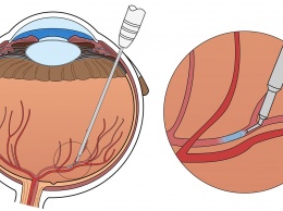 Робот-хирург впервые помог вылечить окклюзию сетчатки