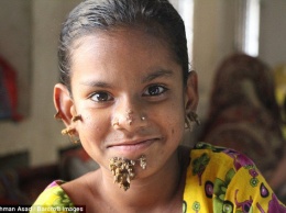 В Бангладеш появилась первая в мире "девочка-дерево"
