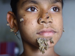 В Бангладеше тело 10-летней девочки покрылось "корой"