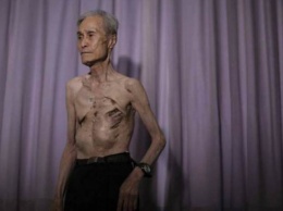 Японец на своем теле показал следы ядерного удара по Нагасаки