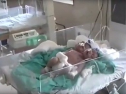 В Индии родился двухголовый младенец с тремя руками (видео)