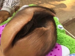 В Камбодже живет ребенок с трещиной в голове, которая постоянно растет