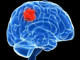 Ученые разработали научно-фантастическую методику лечения опухолей головного мозга