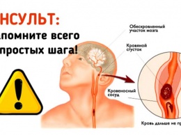 Инсульт: Запомните 3 простых шага, чтобы спасти жизнь себе или близким!