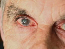 Российские ученые узнали, как можно остановить развитие катаракты