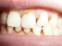 Средство, которое борется с зубным камнем лучше ультразвука!