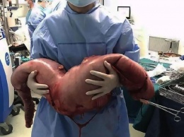 В Китае медики удалили из организма больного 76-сантиметровую опухоль