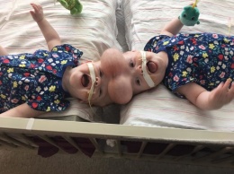 Уникальная операция по разделению двух сиамских близнецов в США длилась 11 часов