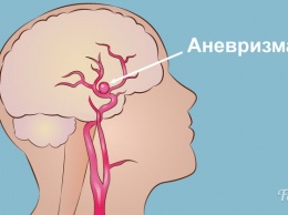 Аневризма cосудов головного мозга: все, что нужно знать, чтобы предотвратить беду