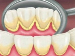 Как удалить зубной налет естественным способом за 5 минут без визита к стоматологу!!!