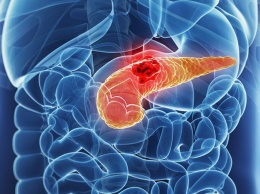 Ученые рассказали, почему рак поджелудочной железы очень агрессивен