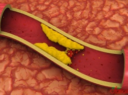 Ученые нашли лучшее «лекарство» от повышенного холестерина