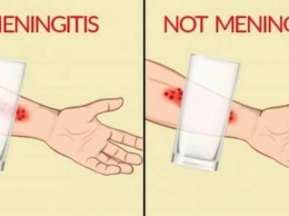 Распознайте признаки менингита: 8 симптомов, о которых вы должны знать!
