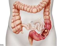 5 признаков колоректального рака, о которых должна знать каждая женщина