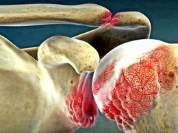 10 симптомов артрит, как предупредить боли суставов?