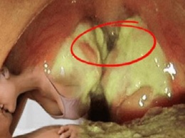 Внимание!!! Будьте осторожны с поцелуями: новый вирус папилломы (ВПЧ) передается через рот