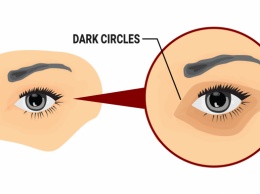 5 простых способов удаления темных кругов под глазами естественным способом