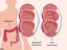 4 опасных признака рака толстой кишки, которые люди обычно просто игнорируют