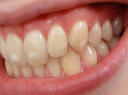 11 полезных советов для лечения белых пятен на зубах
