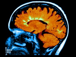 Лекарство от рассеянного склероза уменьшило атрофию мозга, но вызвало головные боли