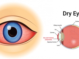 4 простых способа природного лечения сухости глаз