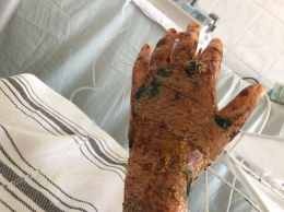 В соцсети опубликовали фото обожженной руки Гандзюк, которую облили серной кислотой