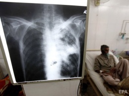Туберкулез остается самой смертоносной болезнью в мире - Всемирная организация здравоохранения