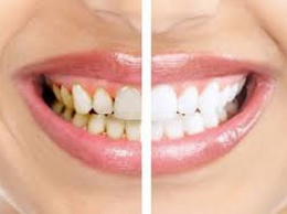 Стоматологи подсказали, как убрать зубной камень