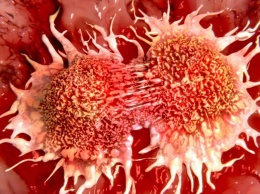 Новая технология позволяет обнаружить рак легких на самой ранней стадии