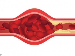 5 тревожных признаков, что ваши артерии уже забиты бляшками