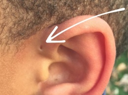 Вот почему некоторые рождаются с крошечными отверстиями в ушах