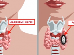 30 симптомов хронического расстройства щитовидной железы