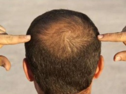 Найден новый генетический виновник раннего прогрессирующего выпадения волос