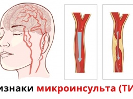 Признаки микроинсульта: Информация, которую должна знать каждая женщина