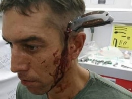 Велосипедист с ножом в голове сам приехал в больницу (фото)