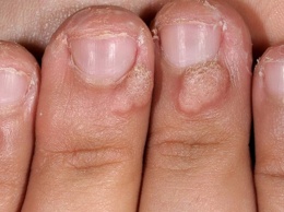 5 ужасных вещей, которые могут случиться с теми, кто грызет ногти