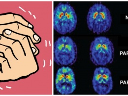 Специалисты изменили противораковый препарат для борьбы с болезнью Паркинсона
