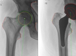 Специалисты из Университета Фраунхофера создали новый тип бедренного импланта