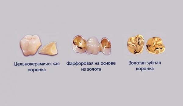 Виды зубных коронок и их применение в стоматологии