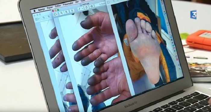 В Сеть попали снимки обмороженных конечностей Элизабет Револь. Медики не исключают ампутацию