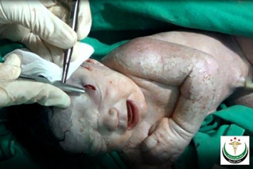 В Сирии родилась девочка со шрапнелью в голове
