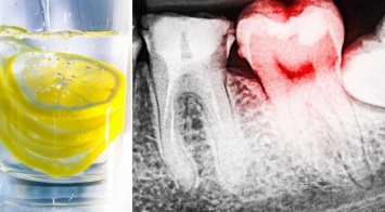 Лимон и лимонный сок разрушают зубную эмаль! Вот как этого избежать