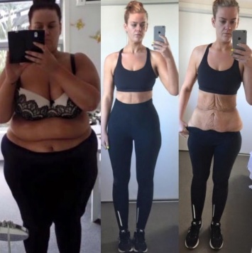Храбрая или безумная: в соцсетях обсуждают новозеландку, похудевшую на 92 кг за 10 месяцев