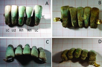 В Италии найден фрагмент древней вставной челюсти