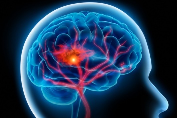 Ученые разработали методику лечения отека мозга