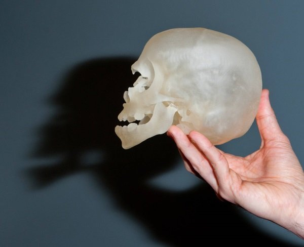 В Китае 3-летней девочке пересадили череп, напечатанный на 3D-принтере