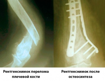 Запорожские травматологи применяют современные методики лечения переломов: остеосинтез вместо неудобного гипса